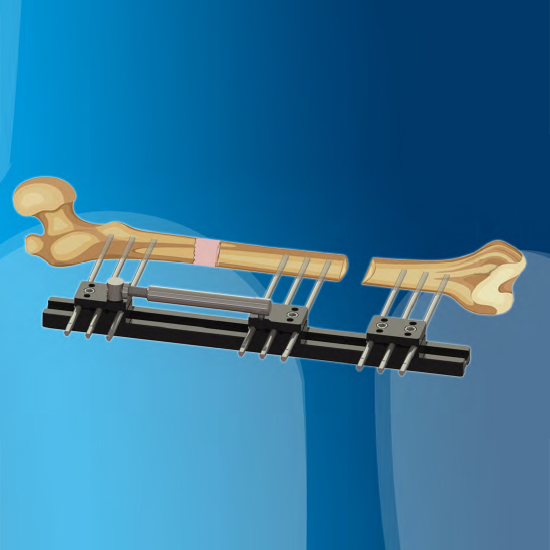 IMD Limb Reconstruction