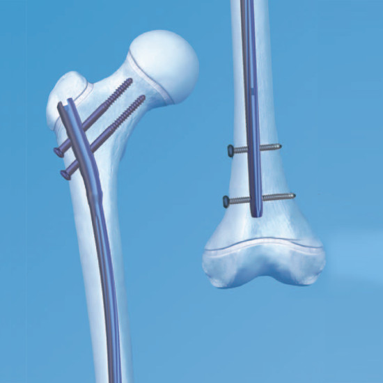Adolesan Femur Pediatric