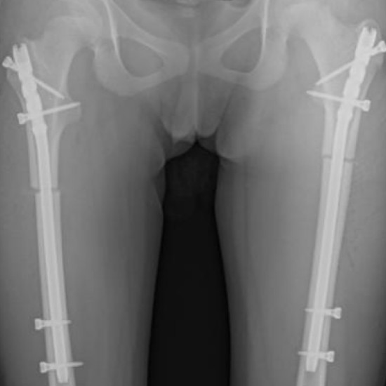 Adolesan Femur Pediatric